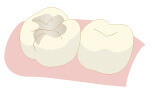 むし歯治療2