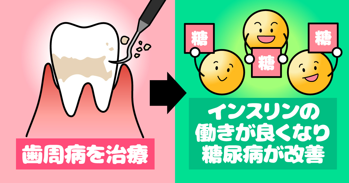 太白区・長町の歯周病治療で糖尿病が改善!?その理由とは