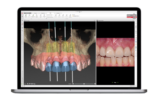 より安心で正確なインプラントシステム - あすと長町歯科（太白区・長町）