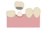 むし歯治療4